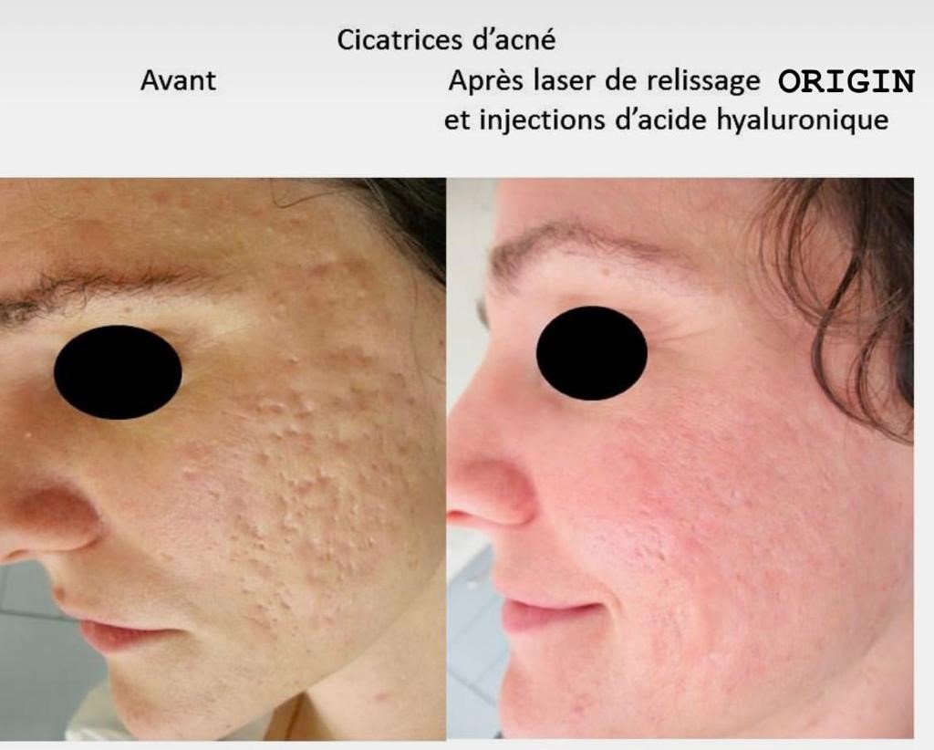 Relissage par laser & traitement des cicatrices | Angers