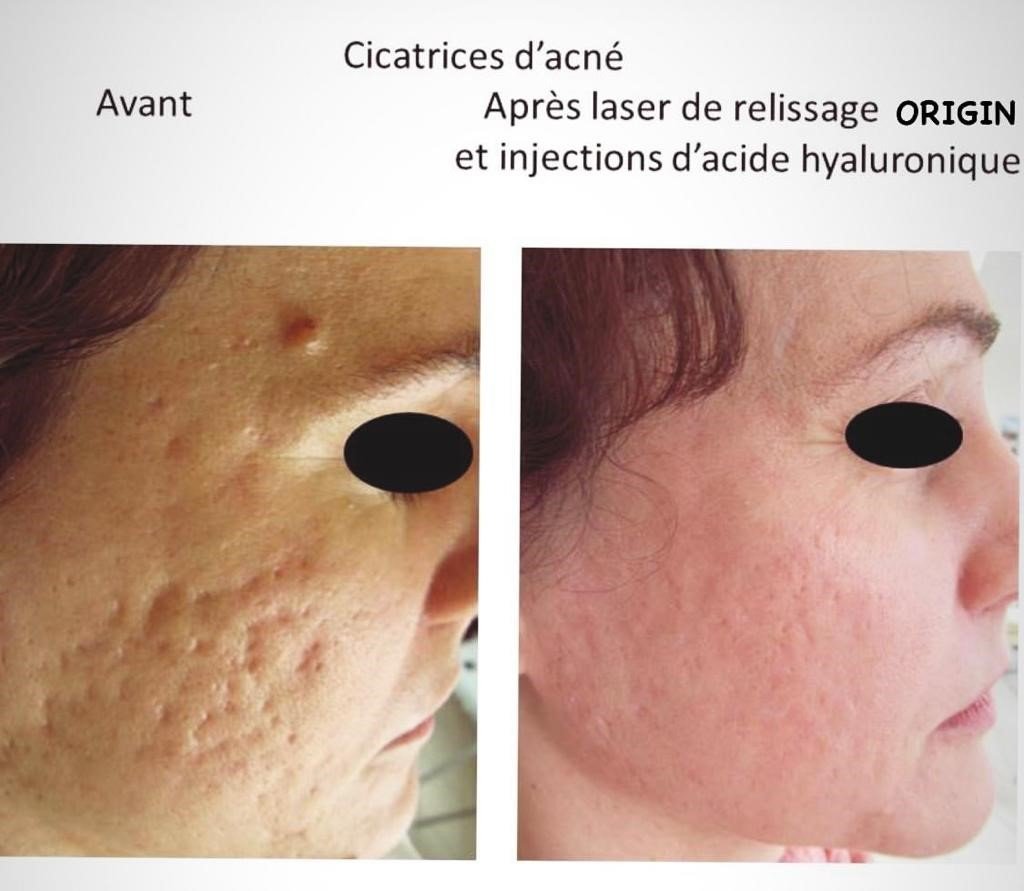 Relissage Par Laser Traitement Des Cicatrices Angers