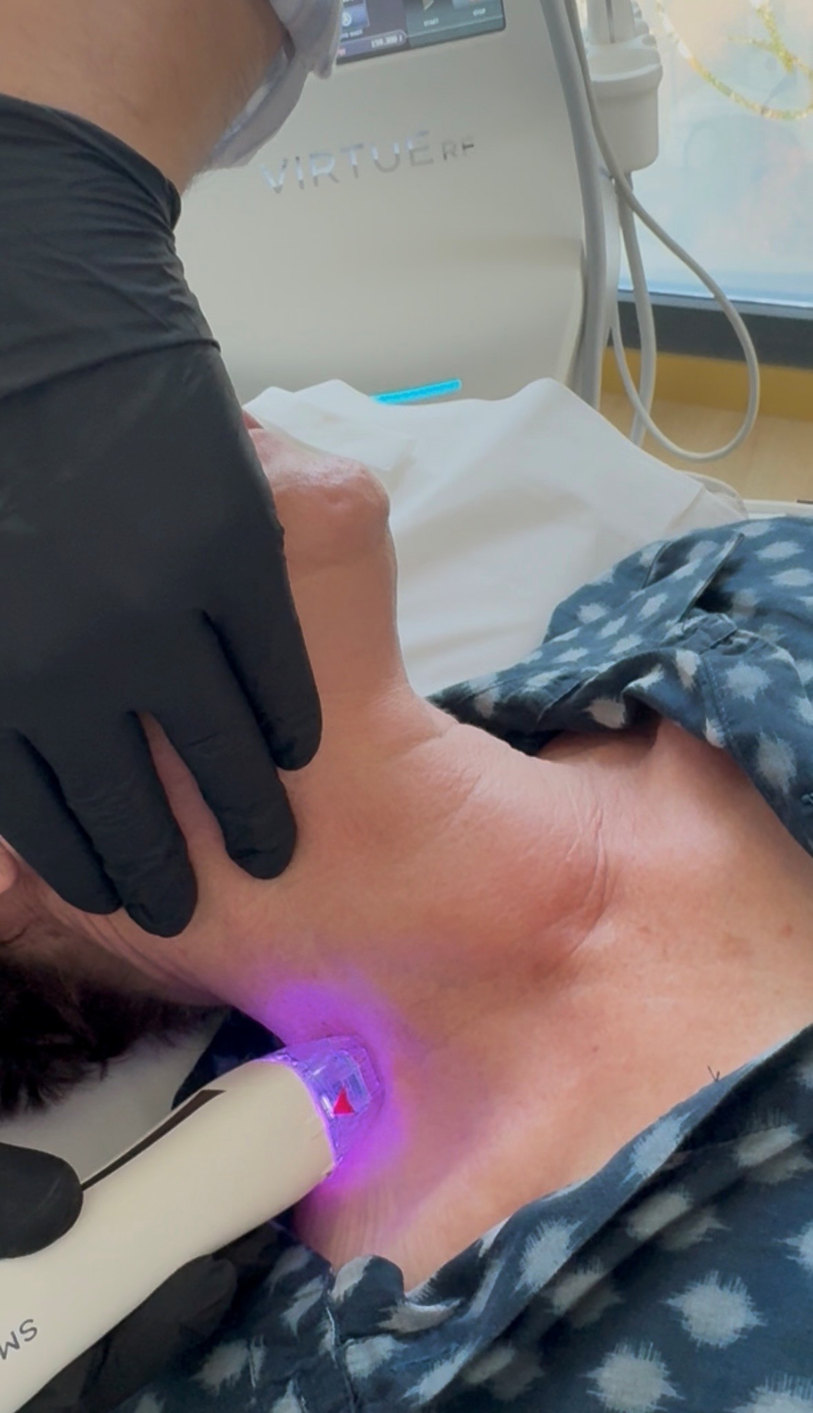 Traitement par Radiofréquence fractionnée micro-aiguilles Virtue RF Dr Nadia Delorme